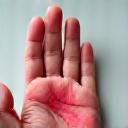 Main avec une zone de peau rougie et sèche, représentant l'eczéma et les irritations cutanées.