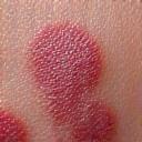 Vue rapprochée de la peau affectée par le psoriasis, avec des plaques rouges et squameuses, symbole d'une affection chronique.